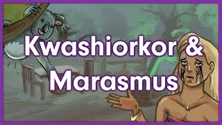 Kwashiorkor vs Marasmus  Nutrition Mnemonic [upl. by Anaujahs]