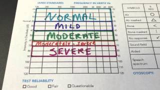 How to Read Your Audiogram [upl. by Anirtak]