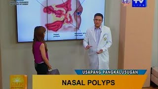 Good Morning Kuya What is Nasal Polyps [upl. by Ahseikal]