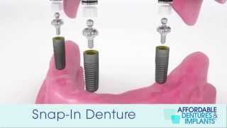 Demo How Do SnapIn Dentures With Implants Work [upl. by Jackqueline]