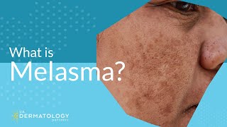 What is Melasma  Melasma Treatment Explained [upl. by Wenda]