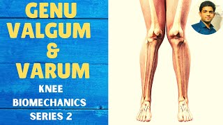 GENU VALGUM amp GENU VARUM  Knee Complex Biomechanics [upl. by Hakym]