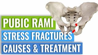 Pubic Ramus Stress Fractures Treatment [upl. by Letnom985]