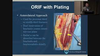 Humeral Shaft Fractures  John Callaghan MD [upl. by Elocan]